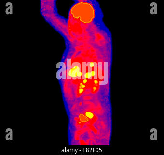 La tomografia ad emissione di positroni (PET) esegue la scansione di un paziente con cancro del retto e metastasi epatiche. Foto Stock