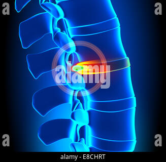 Ernia degenerazione del disco - il problema della colonna vertebrale Foto Stock