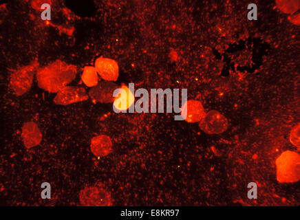 Qui possiamo vedere di Mycobacterium tuberculosis in sputo cospargere è colorato utilizzando acido fluorescente-fast macchia M la tubercolosi è un Foto Stock