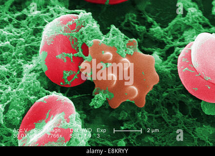 Questo scanning electron microfotografia (SEM) rappresentata numero di cellule rosse del sangue trovato irretito nella matrice fibrinosa su luminali Foto Stock