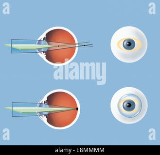 Astigmatismo e correzione con lenti correttive. Foto Stock