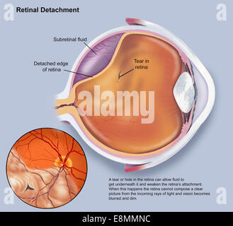 Schema di un distacco della retina. Foto Stock