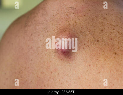 Cisti sebacea infetta sulla schiena di un uomo caucasico Foto Stock