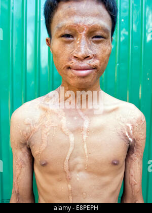 La violenza di acido superstite in Phnom Penh Cambogia. Foto Stock