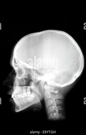 Vista di profilo con un teschio umano X Ray su sfondo nero Foto Stock