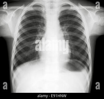 X-ray dei polmoni umani Foto Stock