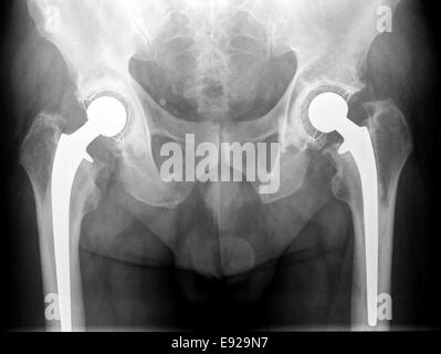 X-ray della protesi dell'anca uomo anziano Foto Stock