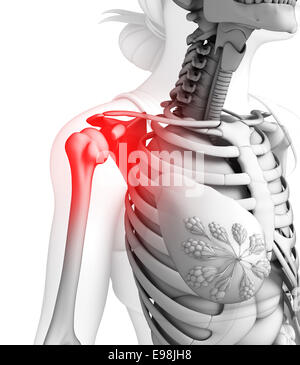 Illustrazione del dolore alla spalla artwork Foto Stock