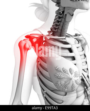 Illustrazione del dolore alla spalla artwork Foto Stock