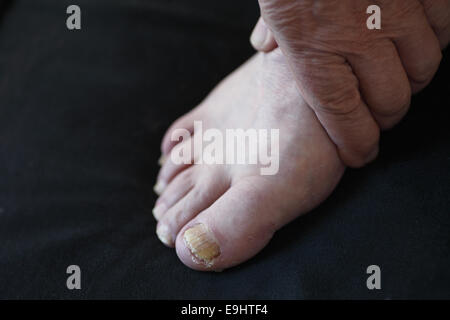 Uomo con una mano sul suo piede con toenail fungo Foto Stock