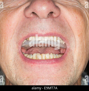 Close up della protezione dei denti in bocca senior Foto Stock