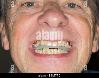 Close up della protezione dei denti in bocca senior Foto Stock