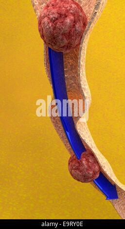 Esame dell'intestino close up su sfondo giallo Foto Stock