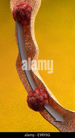 Esame dell'intestino close up su sfondo giallo Foto Stock