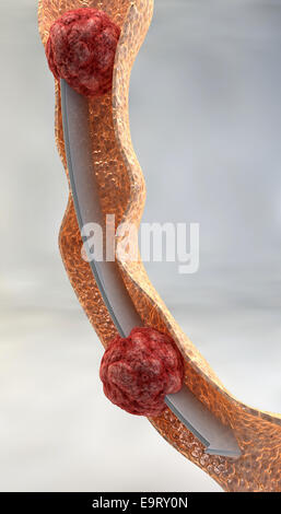 Esame dell'intestino close up su sfondo grigio Foto Stock