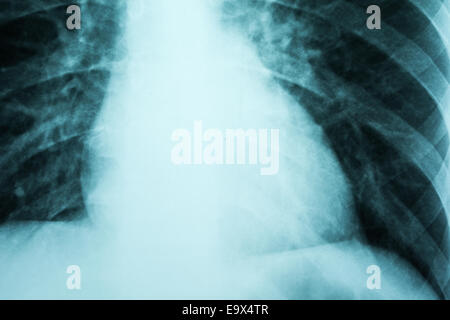 La cardiologia X-Ray del cuore del paziente Foto Stock