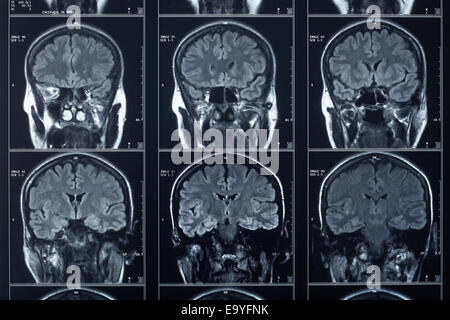 Testata a raggi X e la radiografia del cervello Foto Stock