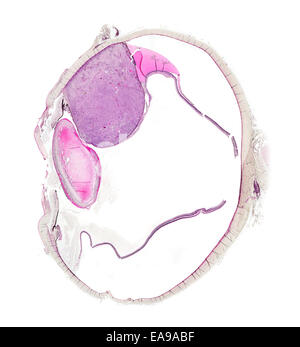 Occhio umano sezione mostrante la struttura con il malato di tumore melanotic (grande zona rosa) fotomicrografia in campo chiaro Foto Stock