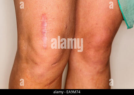 Close up della giovane donna è la gamba e ginocchio con grande cicatrice dopo diversi knee operazioni chirurgiche modello di rilascio: No. Proprietà di rilascio: No. Foto Stock