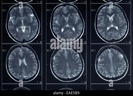 Testata a raggi X e la radiografia del cervello Foto Stock