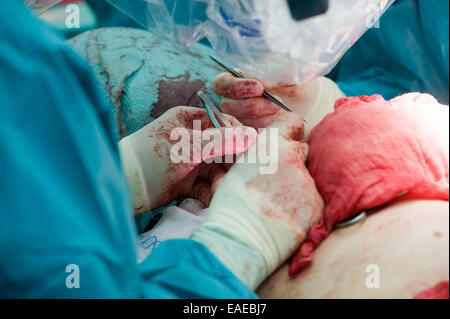Due chirurghi lavorando precisamente insieme durante un'operazione in un ospedale Foto Stock