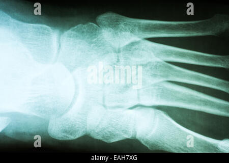Piede umano X-Ray su sfondo nero Foto Stock