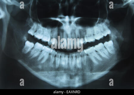 Un dentista di immagine di una donna bocca realizzato da un xray, immagine ad alta risoluzione 24 mp, la xray in sé non era il migliore fatto di qualità Foto Stock