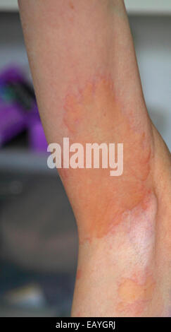 Le ascelle delle donne con grave orticaria a insorgenza di M.E. Foto Stock