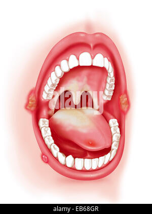Patologia orale, illustrazione Foto Stock