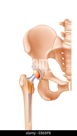Protesi dell'anca, disegno Foto Stock
