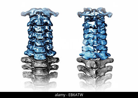 VERTEBRA CERVICALE, illustrazione Foto Stock