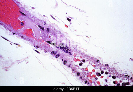 NIPAH infezione da virus Foto Stock