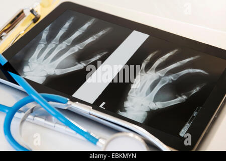 X-ray della mano umana sulla tavoletta digitale Foto Stock