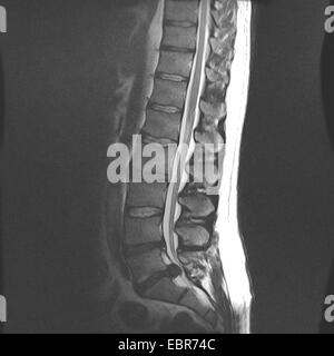 X-ray fotografia della colonna vertebrale ernia del disco tra S5/L1 Foto Stock