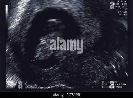 Scansione a ultrasuoni del feto al primo trimestre Foto Stock