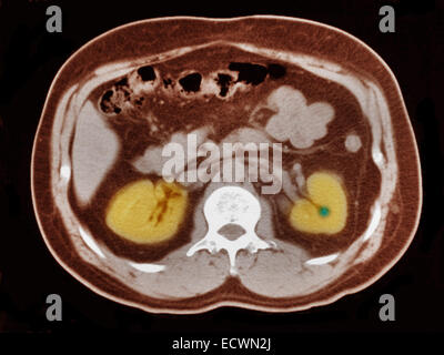 Scansione CT dell'addome che mostra una piccola pietra di rene. Foto Stock