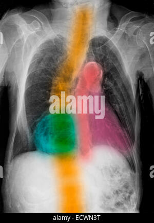 I raggi x al torace che mostra le calcificazioni dell'aorta e la scoliosi. Foto Stock