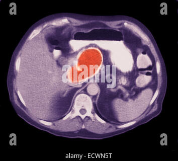 Pseudocyst pancreatica visto in MRI. Foto Stock