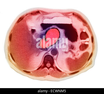 Pseudocyst pancreatica visto in MRI. Foto Stock