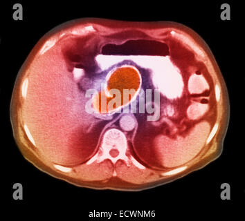 Pseudocyst pancreatica visto in MRI. Foto Stock