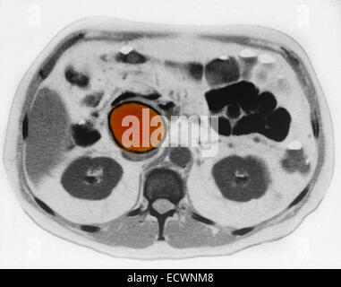 Pseudocyst pancreatica visto in MRI. Foto Stock