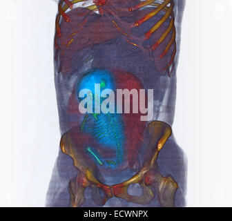 3D CT scan mostra un mandato completo del feto in posizione podalica Foto Stock