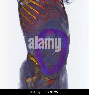 3D CT scan mostra un mandato completo del feto in posizione podalica Foto Stock
