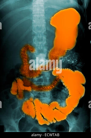 Addome x-ray mostra di bario di materiale di contrasto nell'intestino. Foto Stock