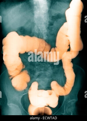 Addome x-ray mostra un contrasto di bario studio del colon. Foto Stock