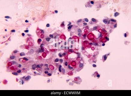 Micrografia luce mostra cryptococcosis del polmone. Foto Stock