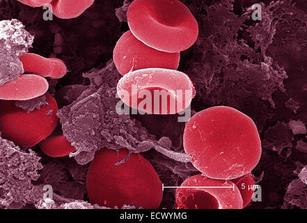 Micrografia al microscopio elettronico a scansione di cellule rosse del sangue e fibrina Foto Stock