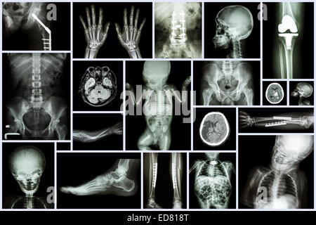 Collezione X-ray più adulto e bambino di organo e di chirurgia ortopedica e multipli per malattia (Cp , osteoartrite del ginocchio Fractu , Foto Stock