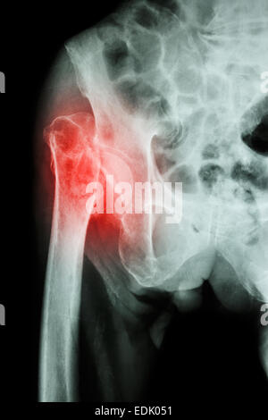 X-ray bacino & hip joint : testa di frattura del femore (thigh bone) Foto Stock