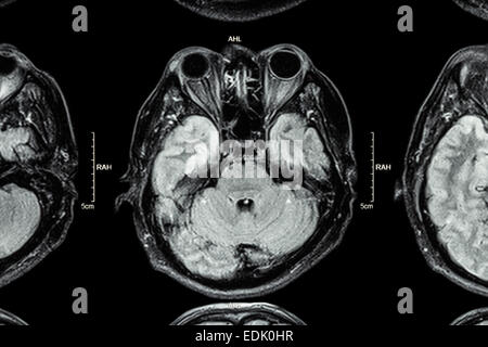 Chiusura del cervello MRI : parte inferiore del cervello ( occhi , del lobo temporale del cervello, cervelletto , stelo cerebrale ) Foto Stock